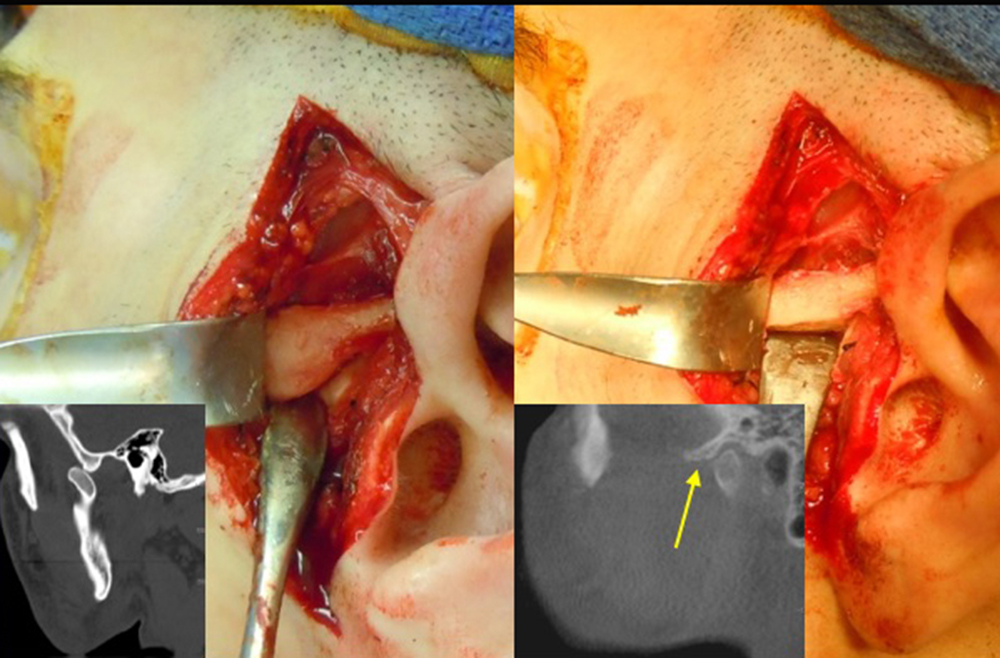 A compartmentalized image demonstrating the effects of TMJ eminoplasty.